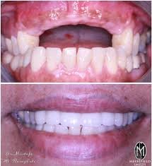 SIX TEETH